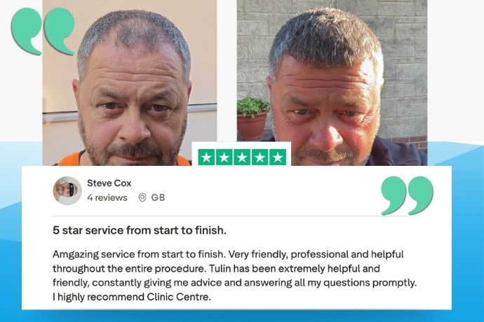 Hair transplant London patient result, photo 2