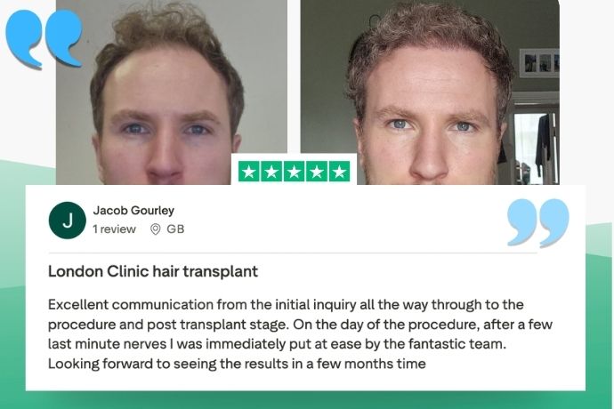 Hair transplant London patient result, photo 3