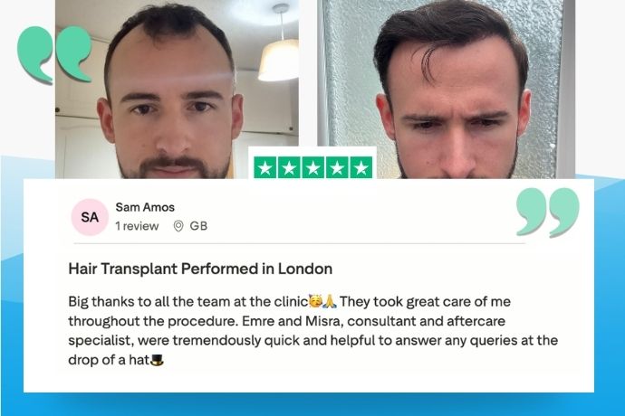 Hair transplant London patient result, photo 1