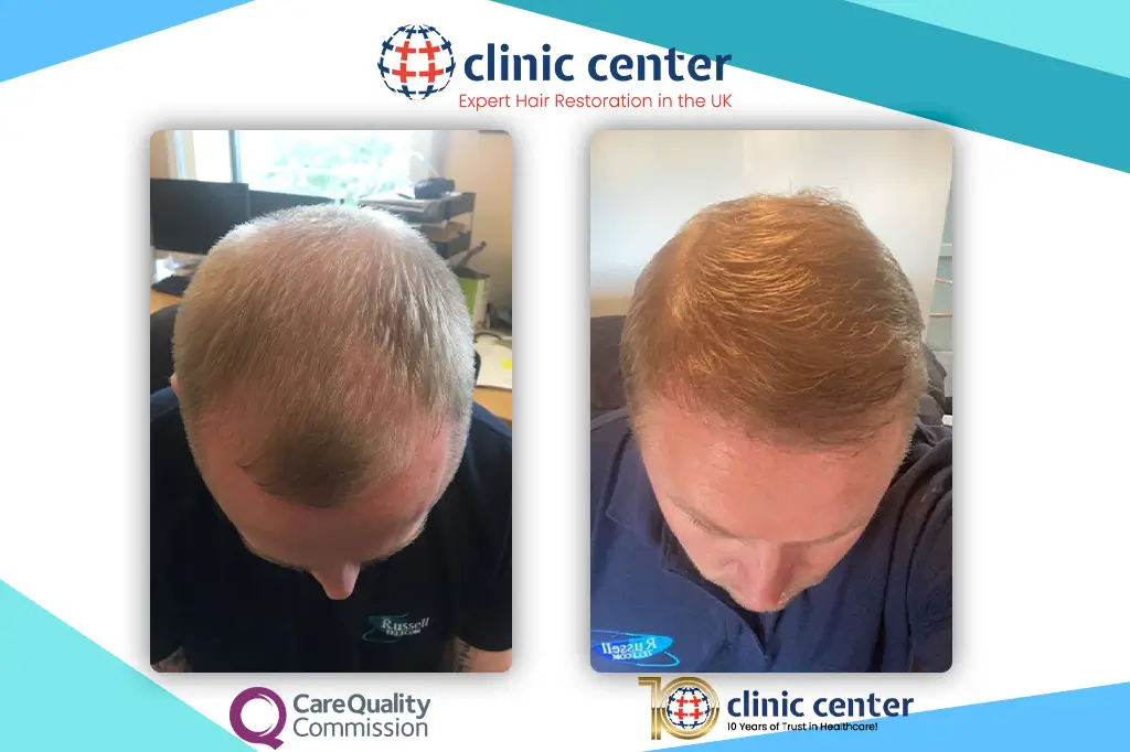 DHI hair transplant before and after results showing a man's thicker crown coverage viewed from above