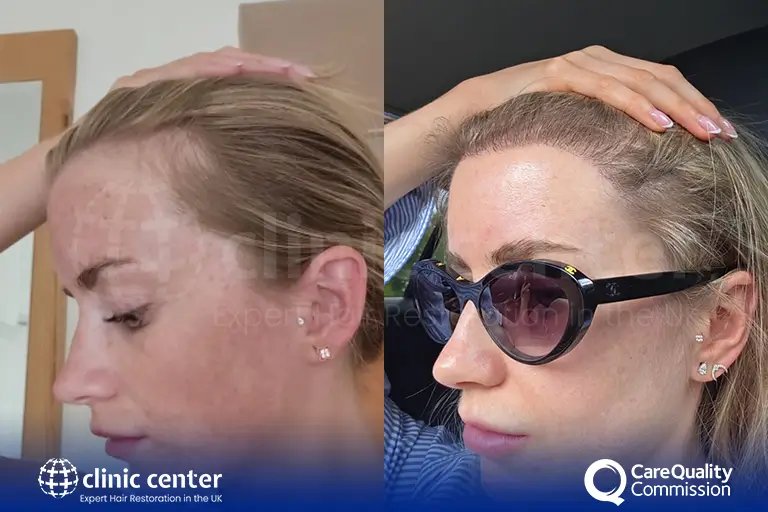 Before and after photo of a female patient's hair transplant hairline results