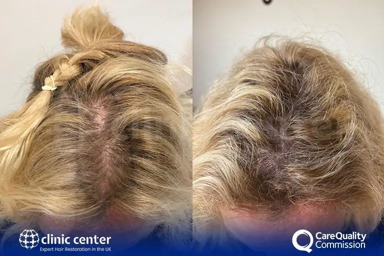 Before and after photo of a female patient's hair transplant results at the crown