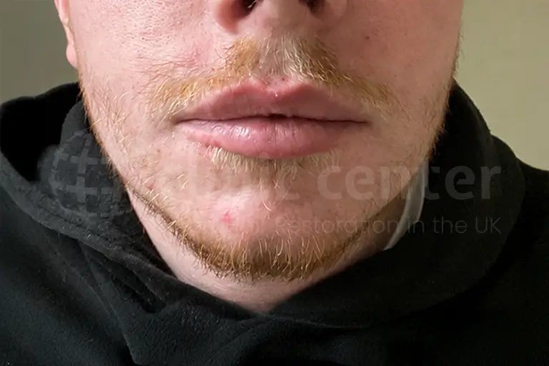 Before